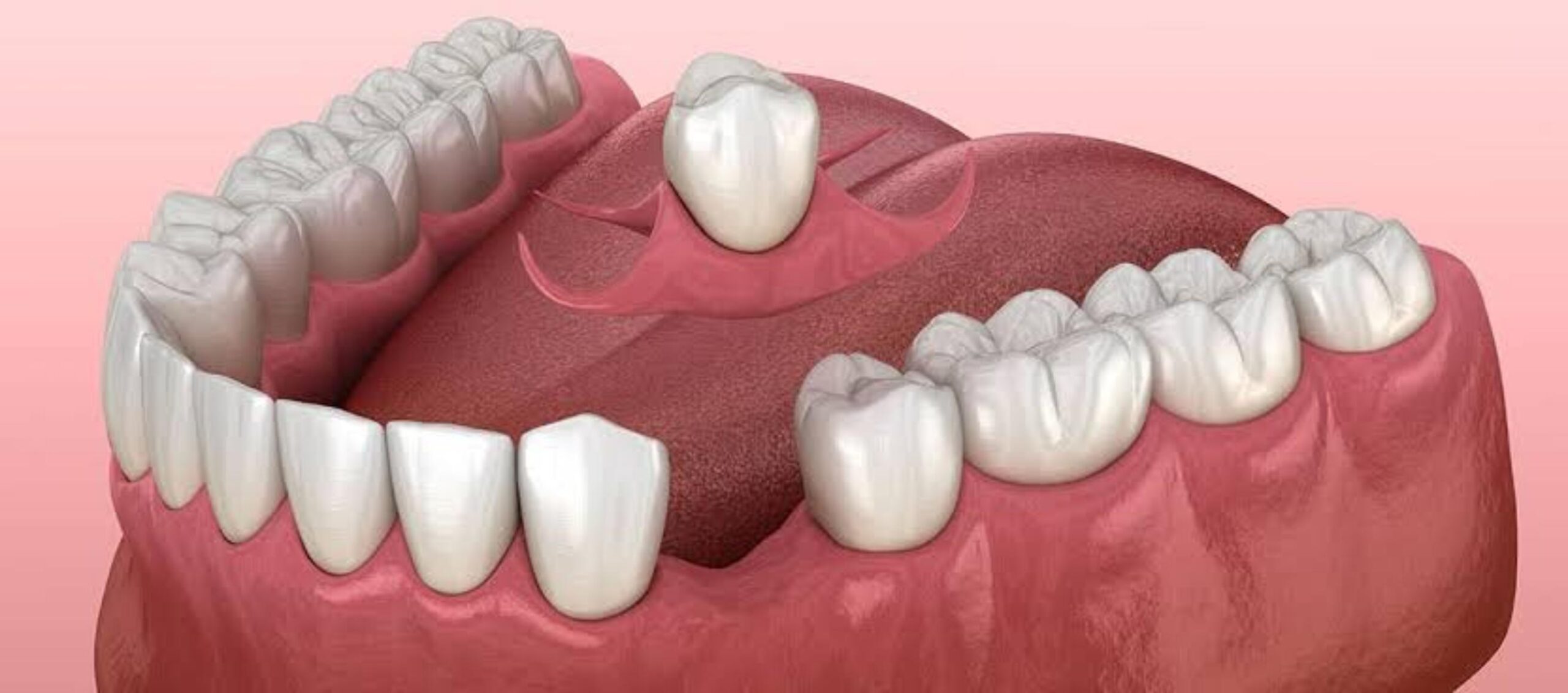 single tooth denture